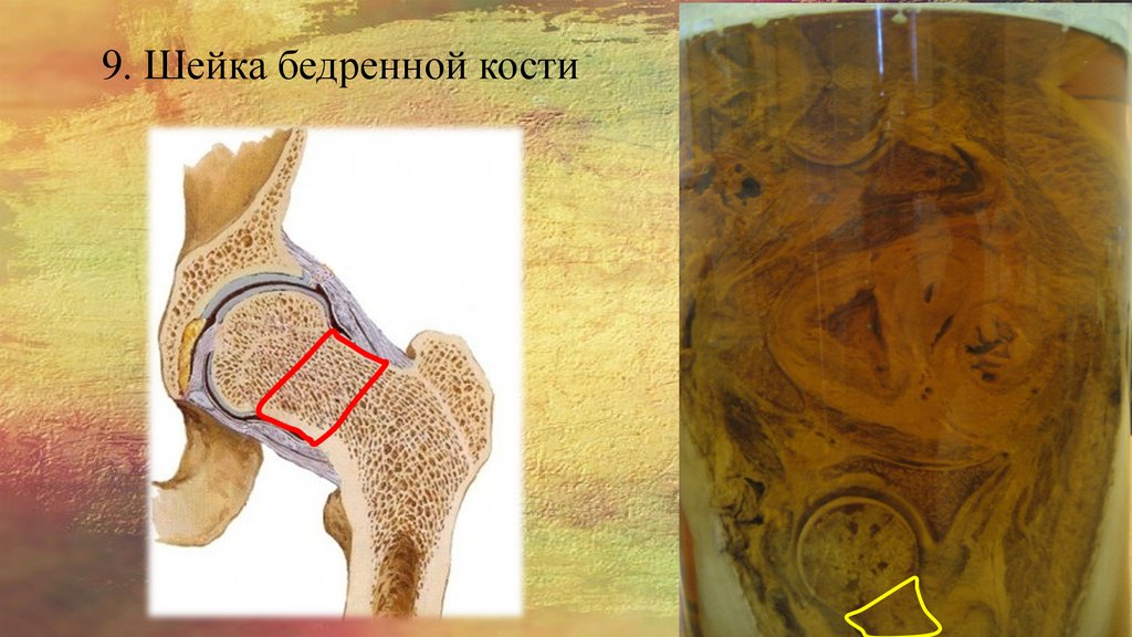 9. Шейка бедренной кости