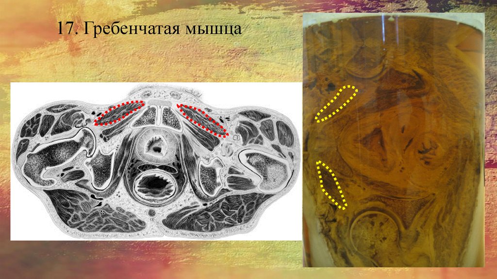17. Гребенчатая мышца
