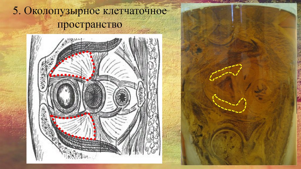 5. Околопузырное клетчаточное пространство