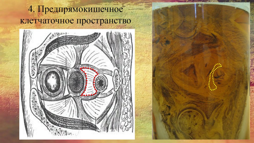 4. Предпрямокишечное клетчаточное пространство