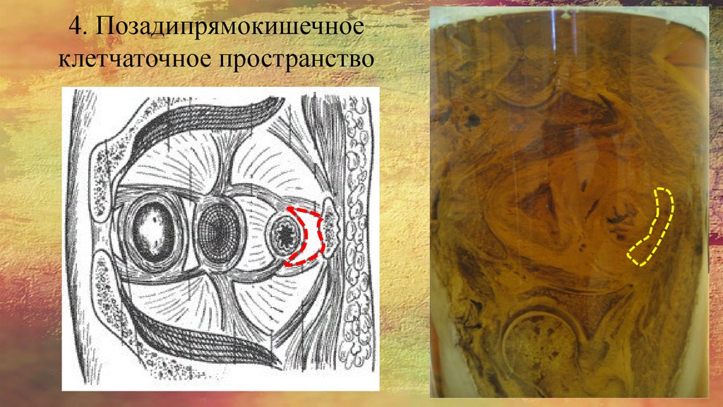 4. Позадипрямокишечное клетчаточное пространство