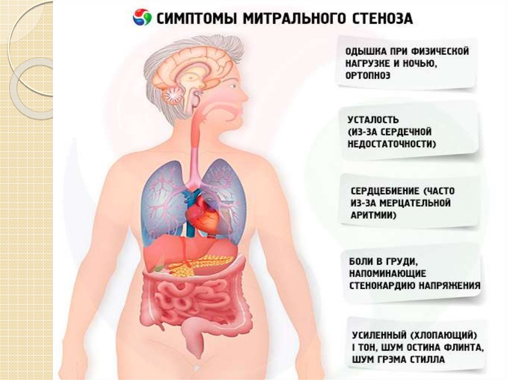 Утомляемость сердца. Стеноз митрального клапана симптомы. Митральный стеноз симптомы. Симптомы митральной регургитации. Признаки митрального стеноза.