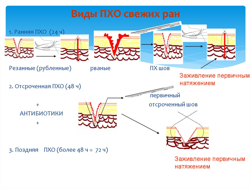Чем обработать операции швы. Поздняя первичная хирургическая обработка РАН. Ранняя первичная хирургическая обработка. Отсроченная первичная хирургическая обработка.