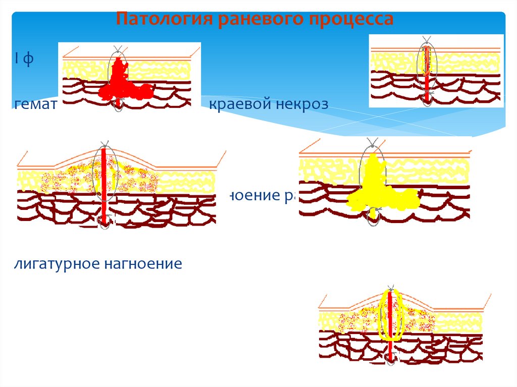 Раневой процесс