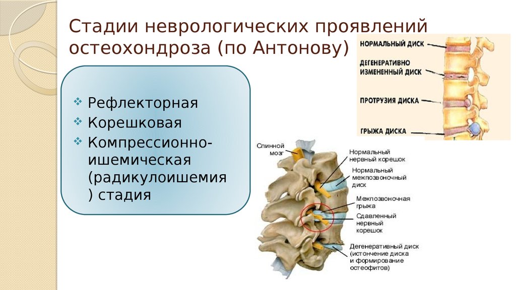 Стадии неврологических проявлений остеохондроза (по Антонову)