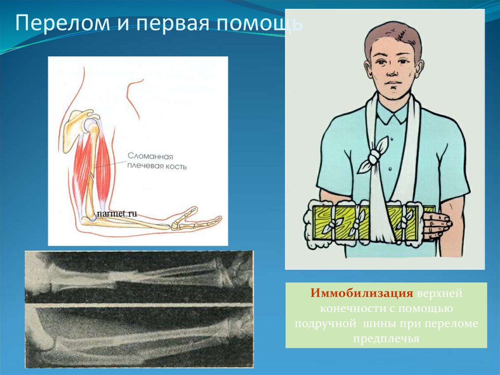 Презентация первая помощь при травмах растяжении связок вывихах суставов переломах костей 8 класс