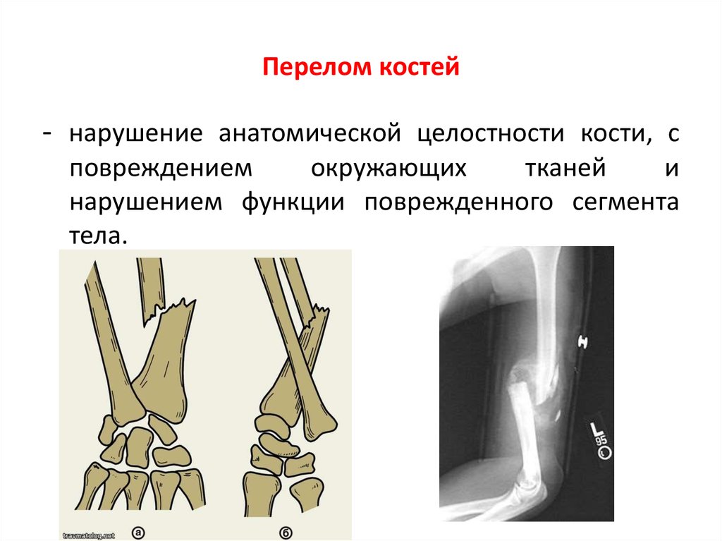 Переломы вывихи презентация