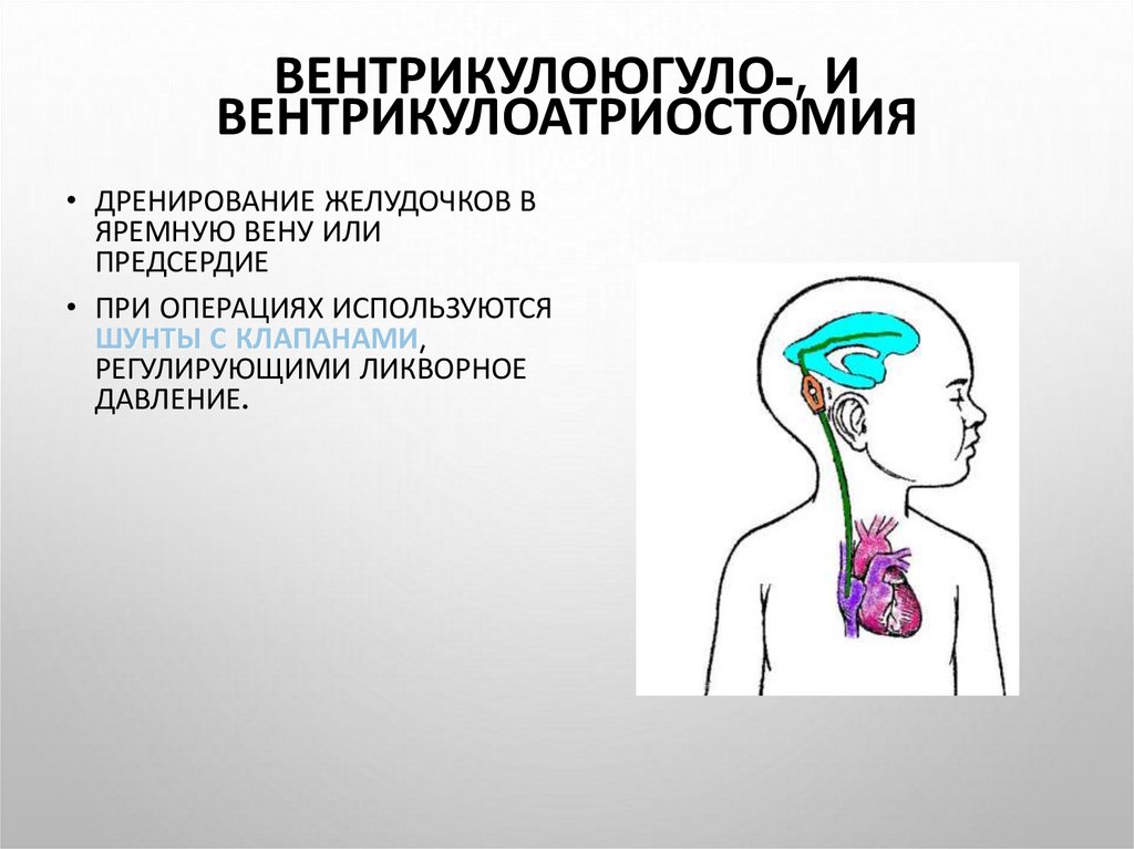 Операция гидроцефалия мозга. Вентрикулоатриостомия. Вентрикулоперитонеостомия шунт. Вентрикулоатриостомия и вентрикулоперитонеального. Вентрикулоперитонеостомия картинки.