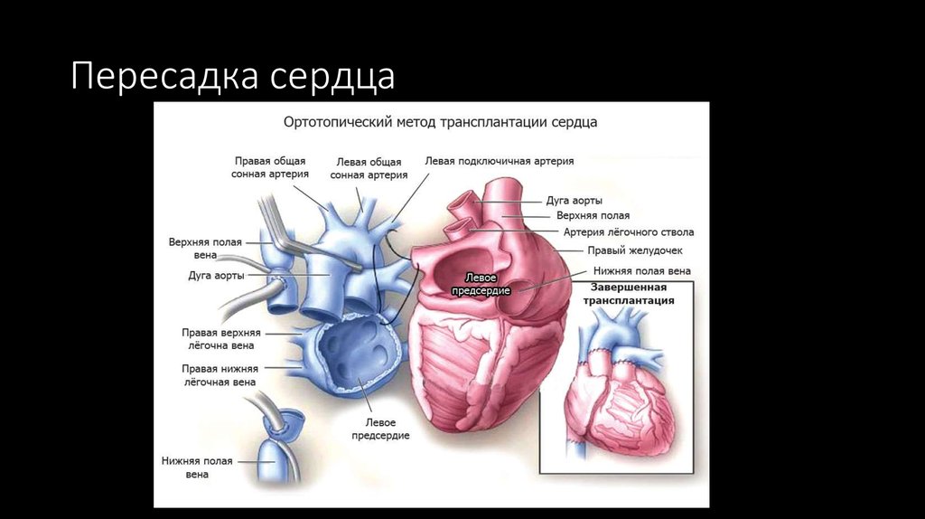 Меняю сердце