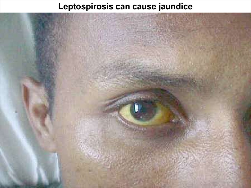 Лептоспироз гепатит