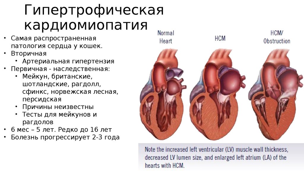 Кардиомиопатия предсердий. Гипертрофическая кардиомиопатия. Гипертрофия кардиомиопатия. Первичные и вторичные кардиомиопатии. УЗИ сердца при кардиомиопатии.