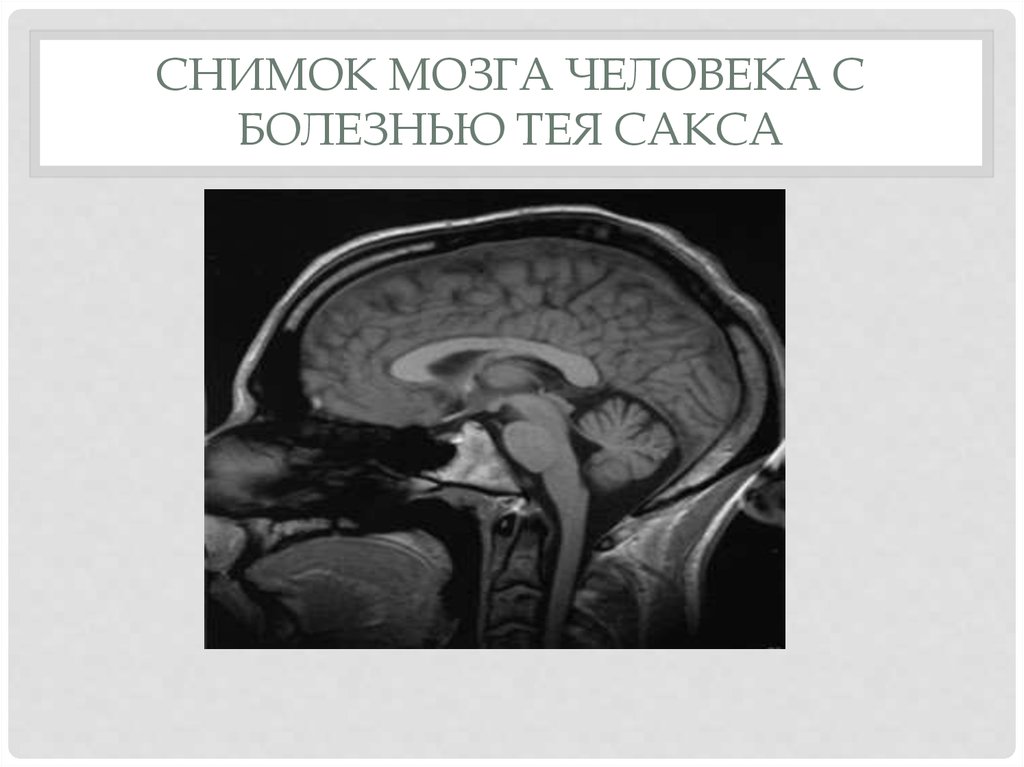 Болезнь тея сакса картинки