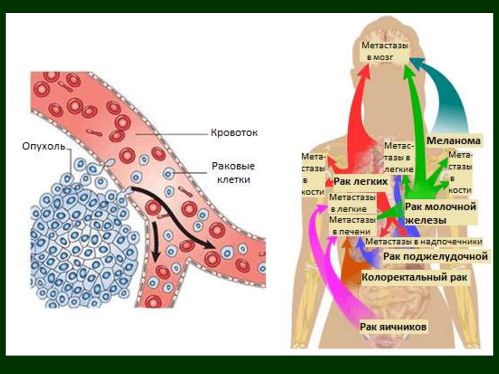 Метастазирующих меланом. Гематогенный путь метастазирования опухоли. Лимфогенный путь метастазирования. Метастазирование опухолей лимфогенный путь пути. Гематогенное распространение метастазов схема.