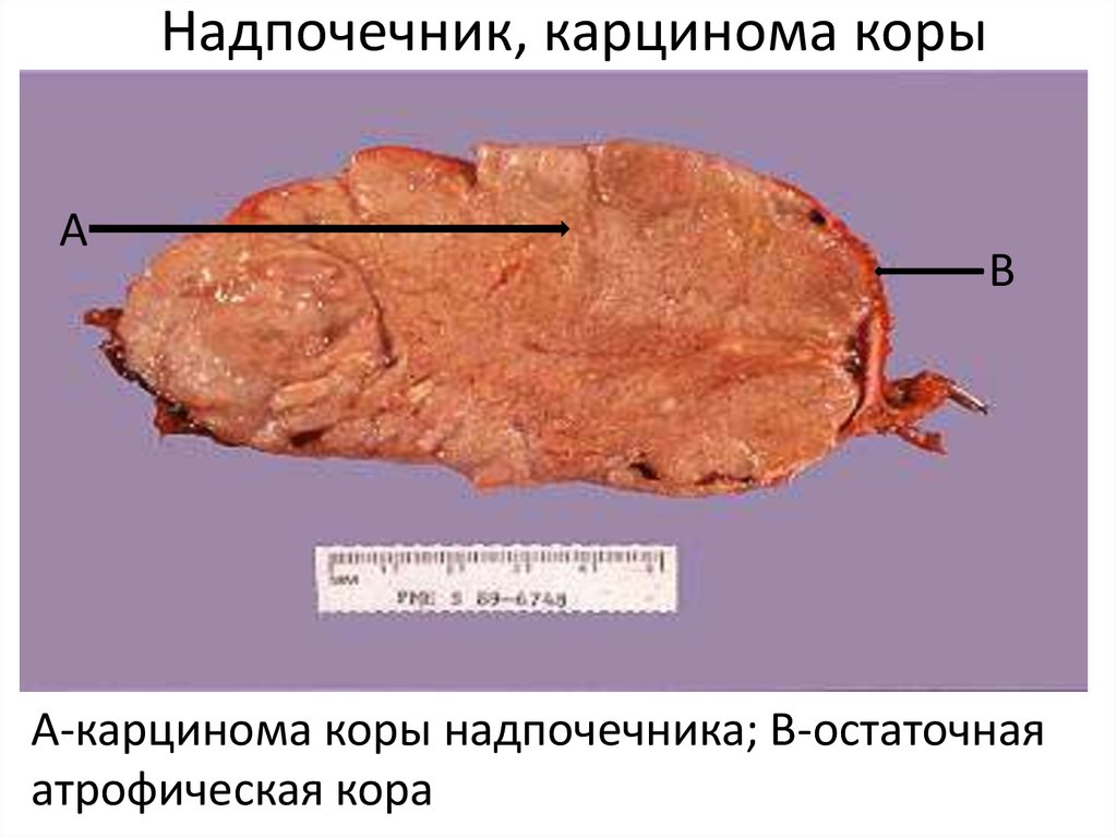 Базальноклеточная карцинома фото и описание