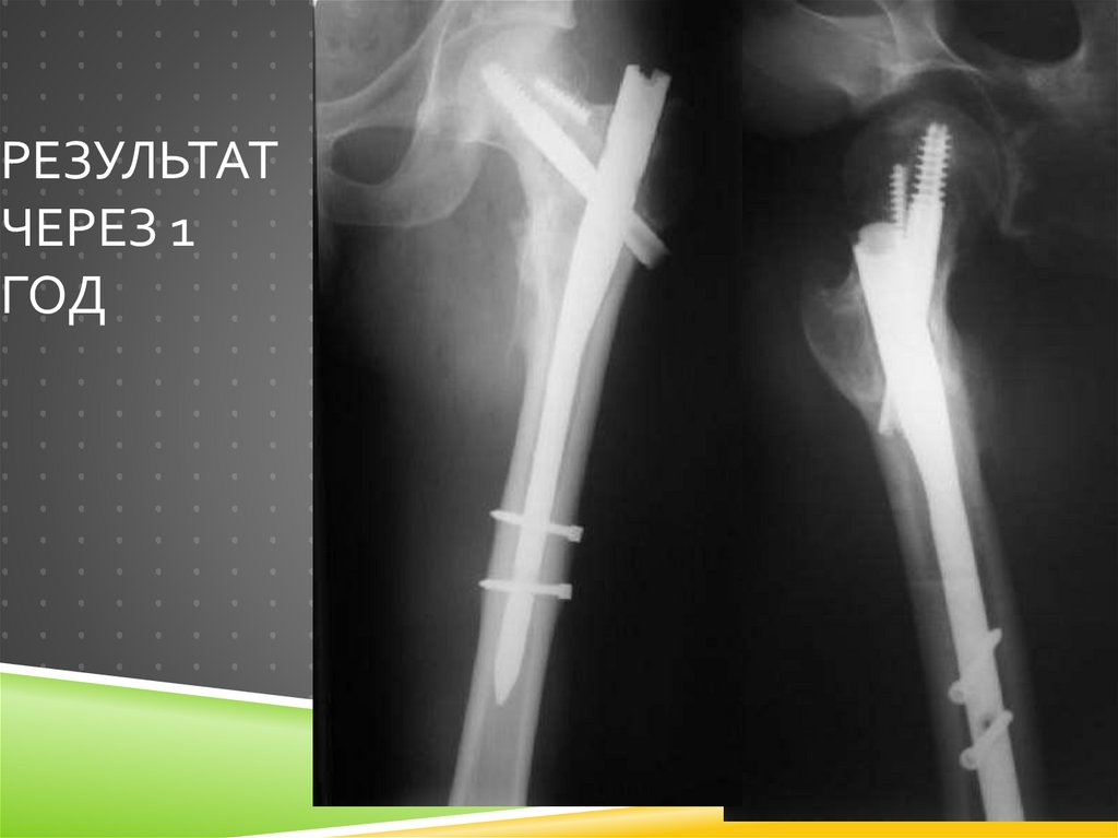 Результат через 1 год