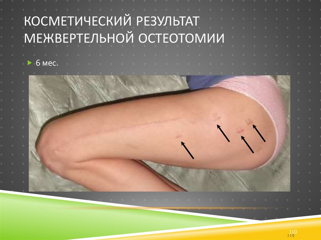 Косметический результат межвертельной остеотомии