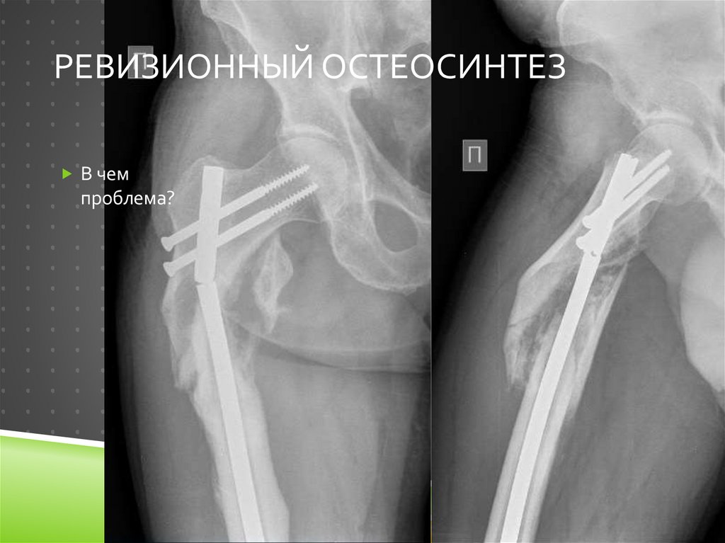 Ревизионный остеосинтез