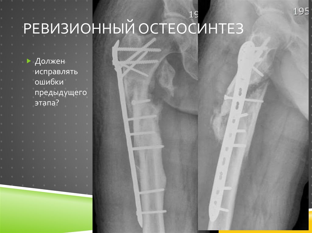 Осложнения остеосинтеза. Шрам после остеосинтеза. Стабильный и нестабильный остеосинтез. Шрамы после остеосинтеза на руке. Шрамы после остеосинтеза голени.