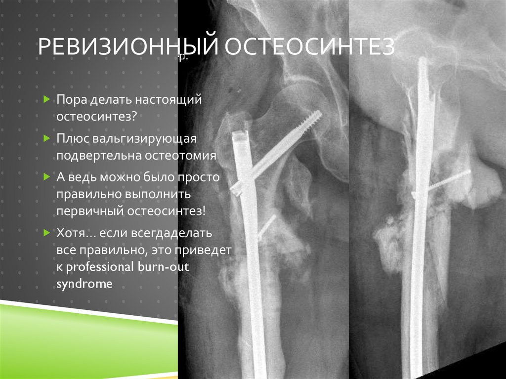 Ревизионный остеосинтез