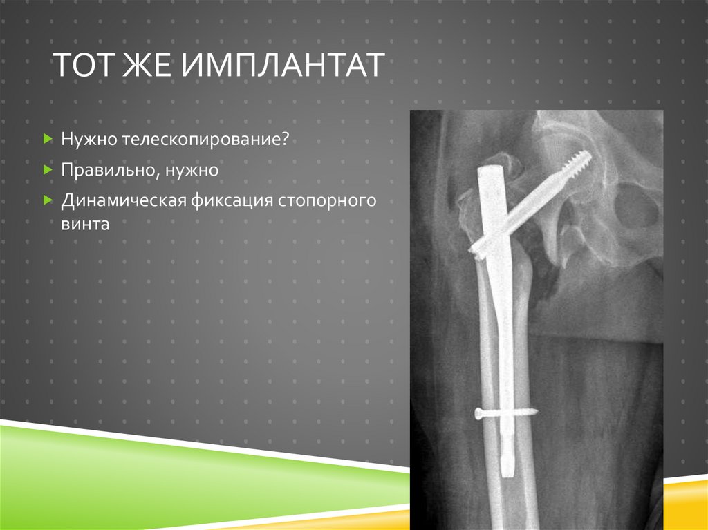 Тот же имплантат