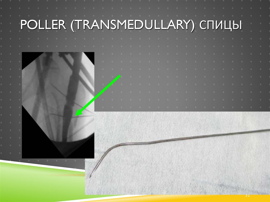 Poller (transmedullary) спицы