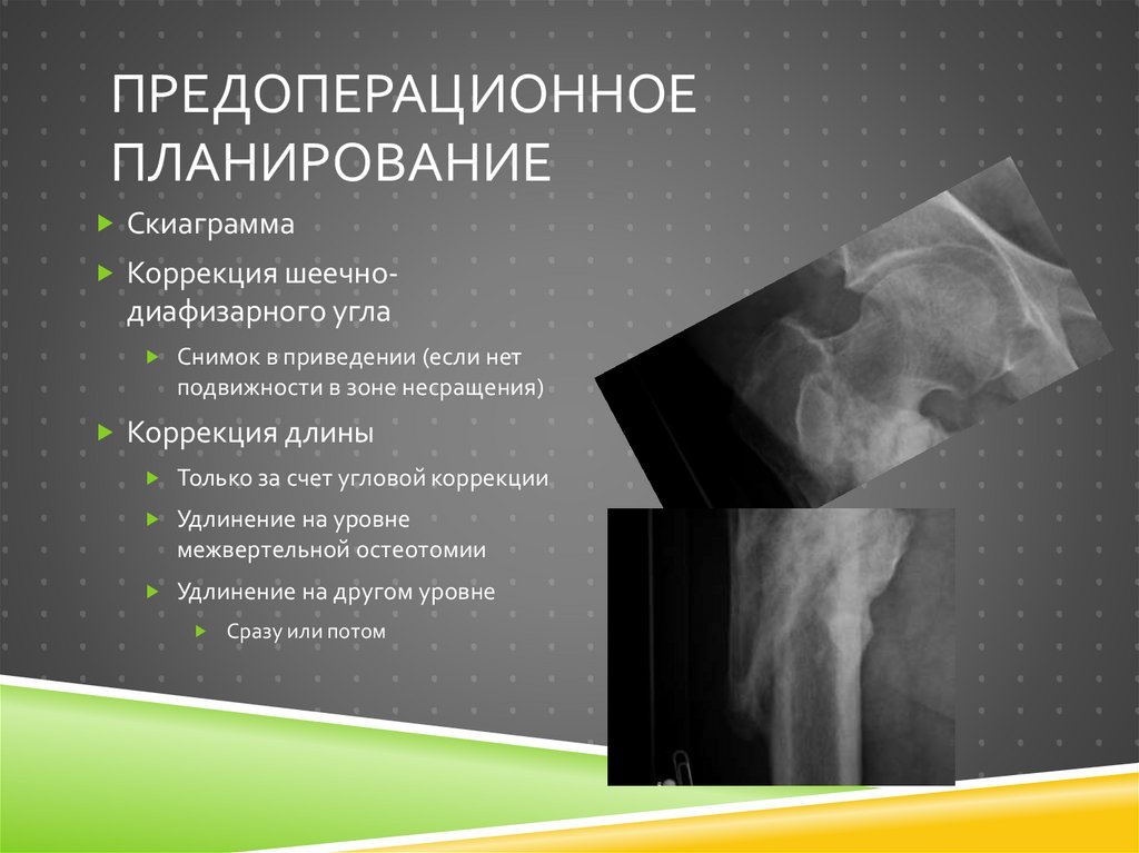 Предоперационное планирование