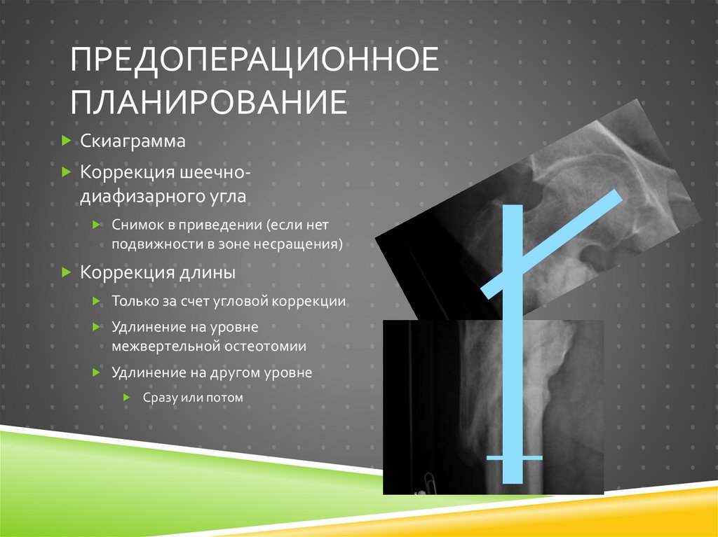 Предоперационное планирование