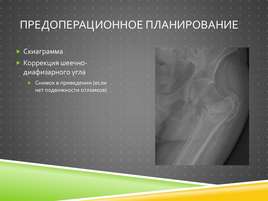Предоперационное планирование