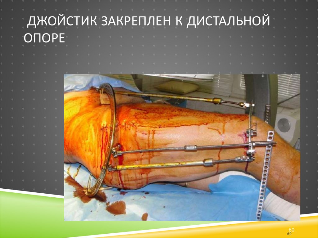 Джойстик закреплен к дистальной опоре