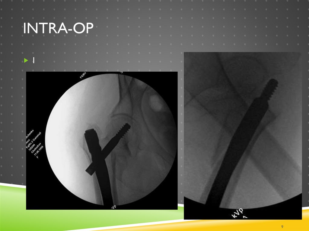 Intra-op