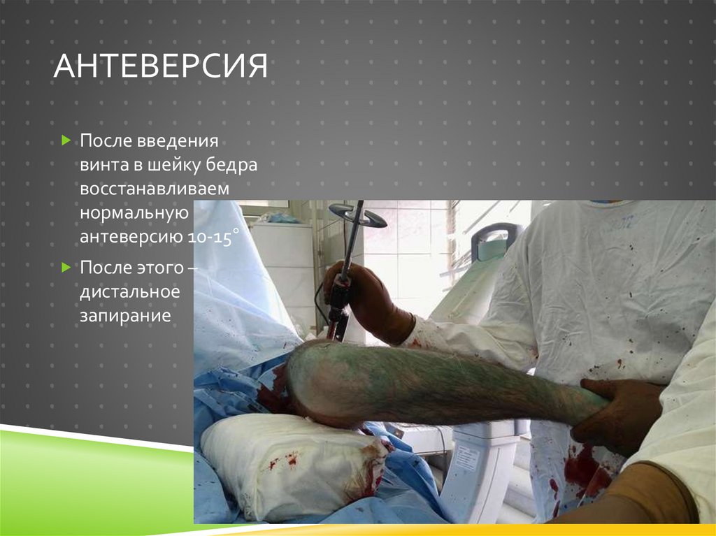 антеверсия