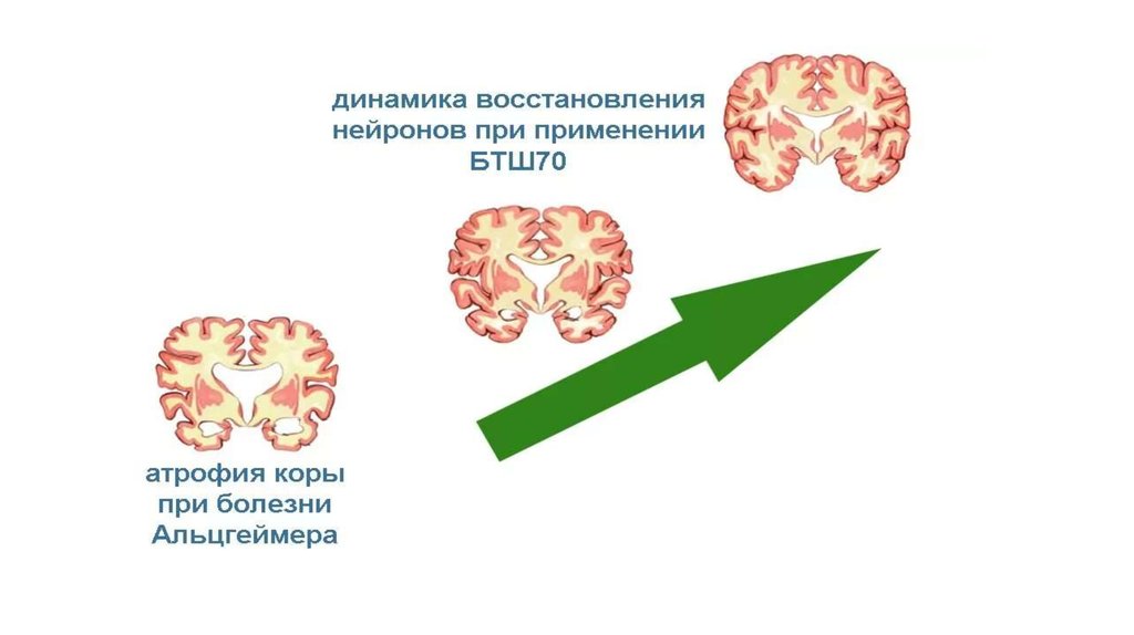 Лечение альцгеймера 88003505509