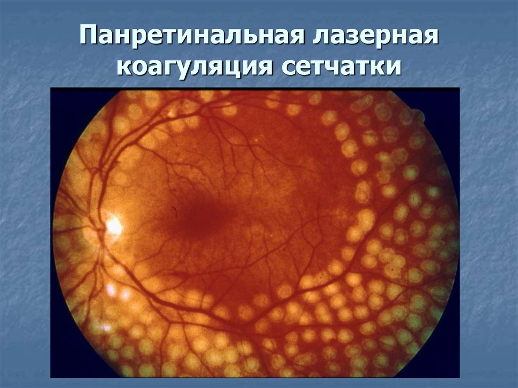 Глаз после лазерной коагуляции сетчатки. Диабетическая ретинопатия лазерная коагуляция. Лазеркоагуляция сетчатки глаза. Отграничительная лазеркоагуляция сетчатки глаз.
