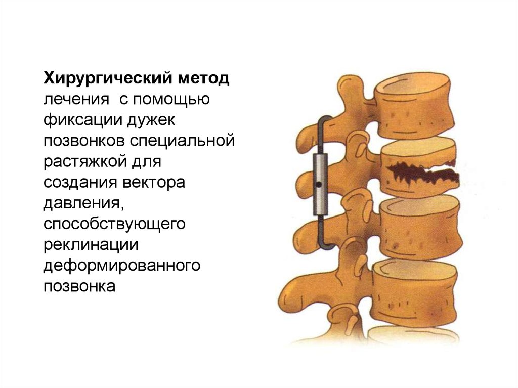 Деформация позвонков