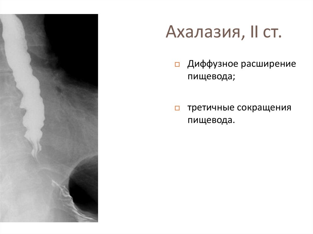 Ахалазия кардии презентация