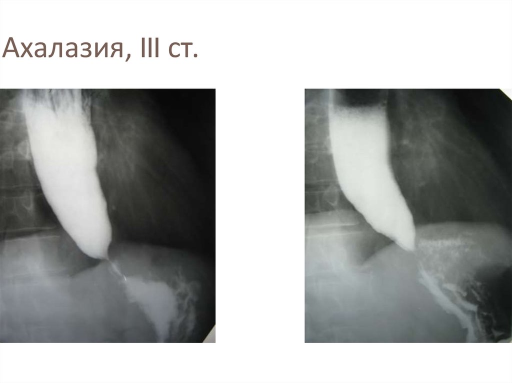 Какой из перечисленных симптомов является ведущим в рентгенологической картине ахалазии пищевода