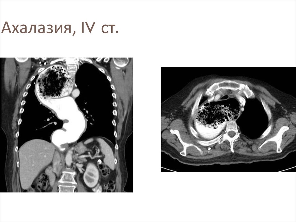 Ахалазия пищевода презентация