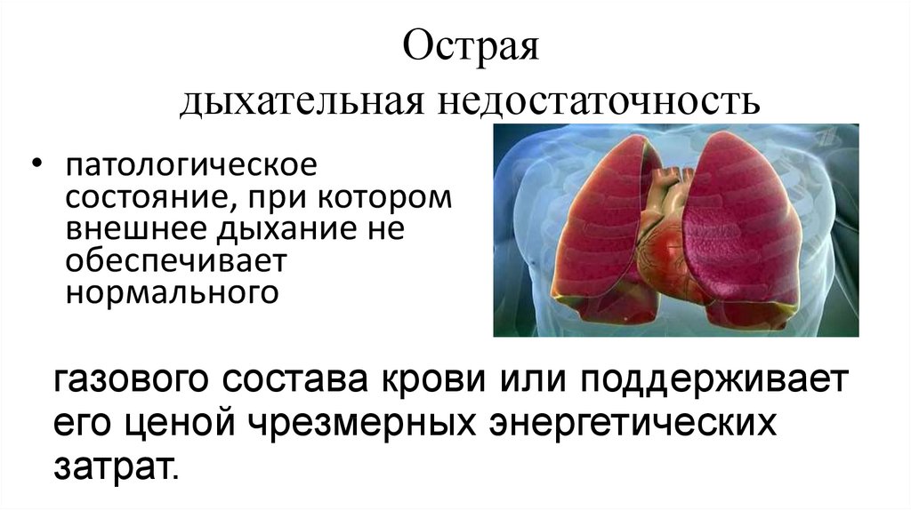 Острая дыхательная недостаточность картинки