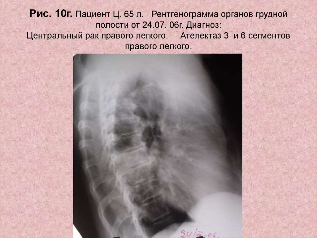 Рак правого. Ателектаз 6 сегмента рентген. Ателектаз 6 сегмента правого легкого. Г 10 диагноз.