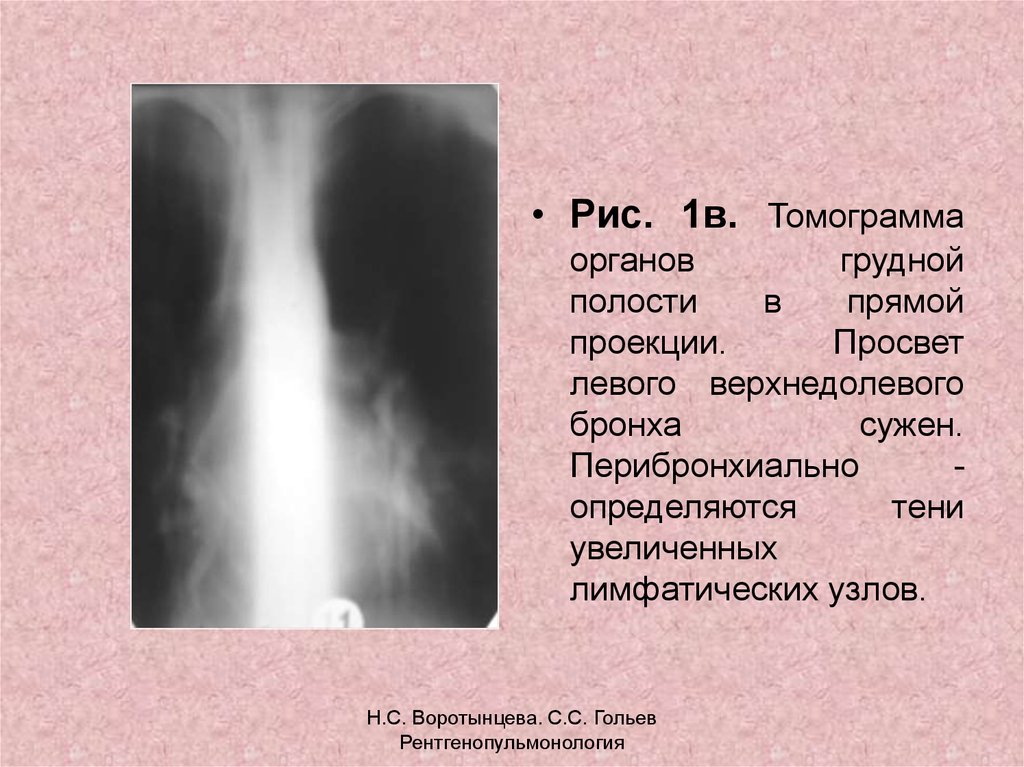 Просвет бронхов. Просветы главных бронхов. Левый верхнедолевой бронх. Просветы главных бронхов не сужаются вследствие того что. Аномалии верхнедолевого бронха.