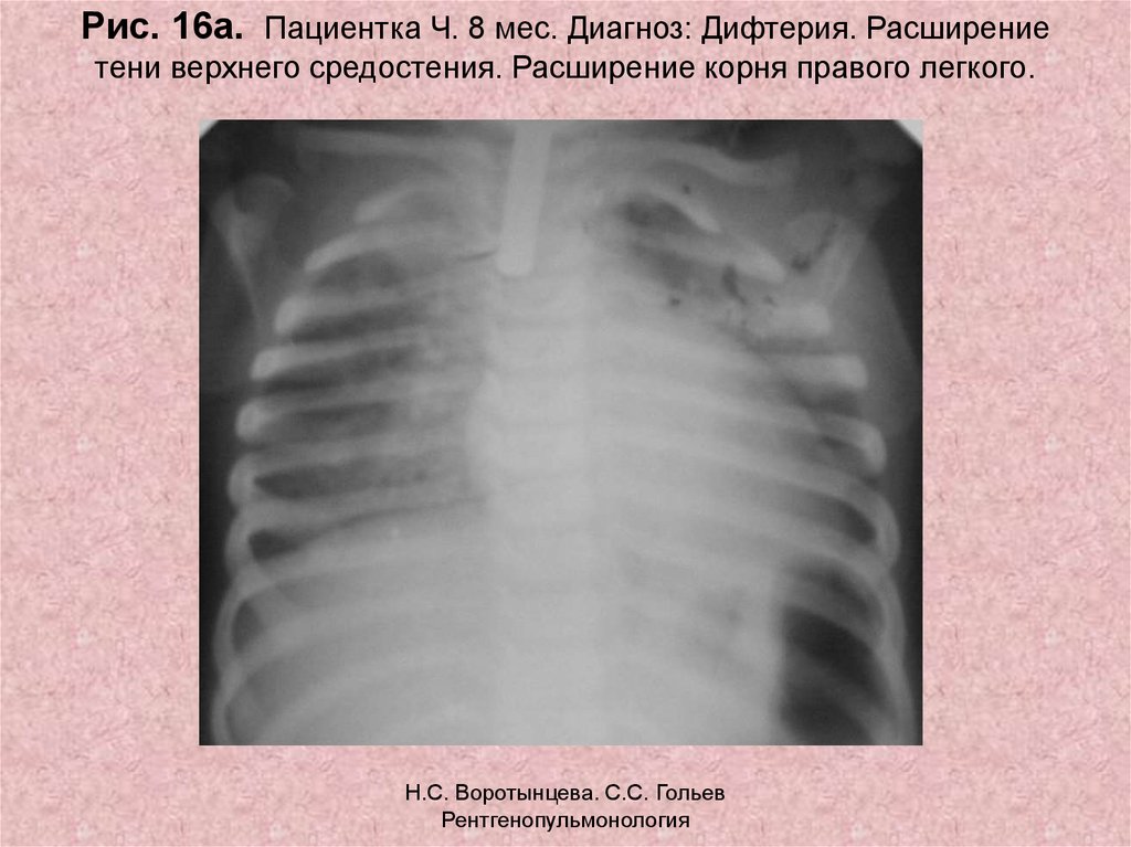 Расширение корня легкого