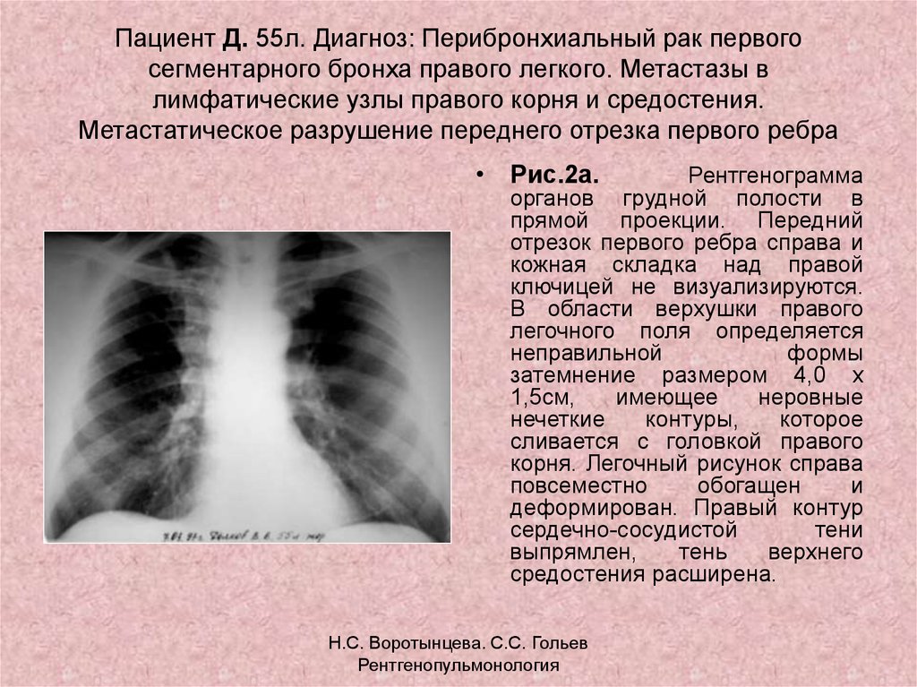 Легочный рисунок усилен за счет перибронхиального компонента