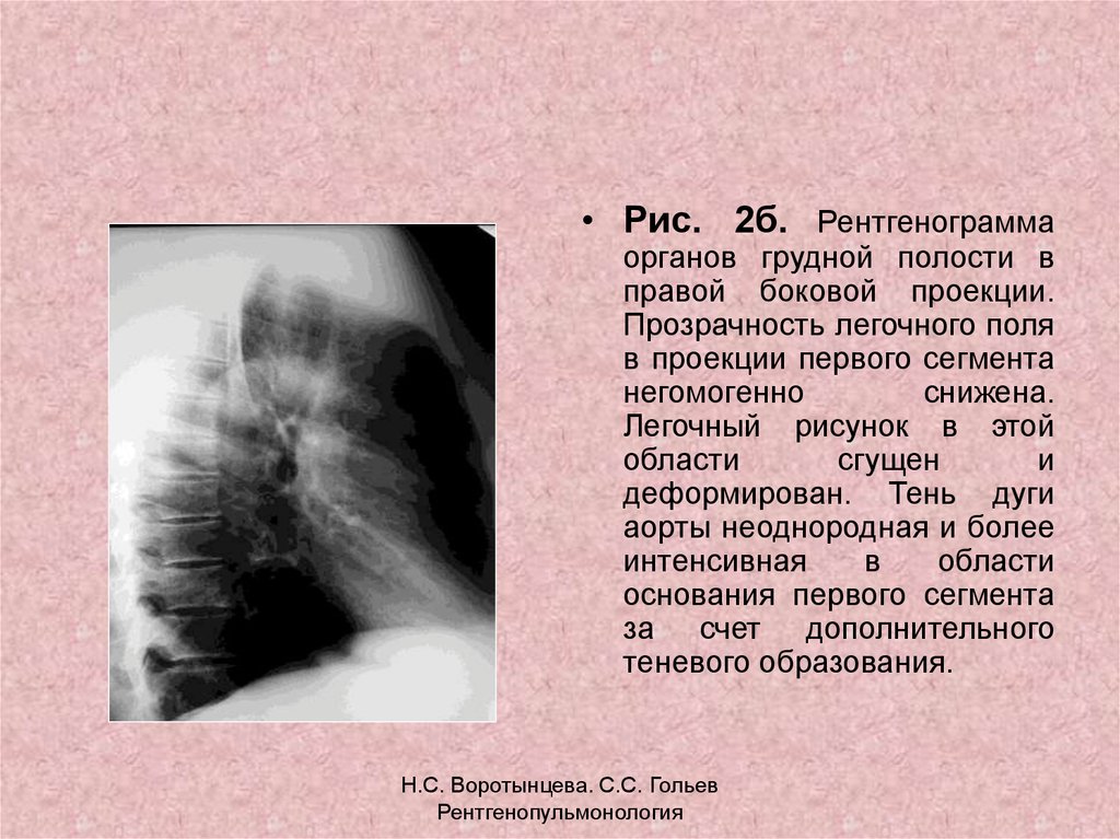 Легочный рисунок. Рентгенограмма органов грудной полости в боковой проекции:. Снижение прозрачности легочных полей. Понижение прозрачности легочного поля. Рентгенограмма в правой боковой проекции.