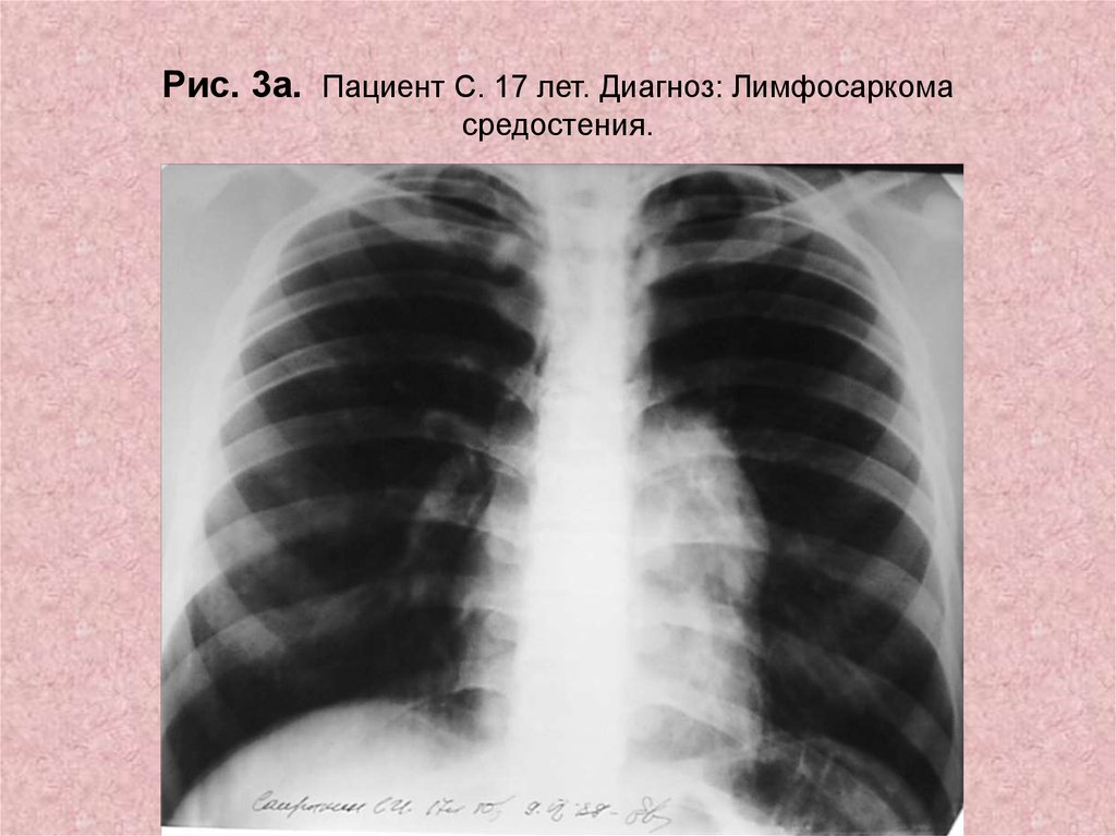 Лет диагноз. Медиастинальная лимфосаркома. Лимфосаркома средостения. А17 диагноз. Осложнения лимфосаркомы средостения.