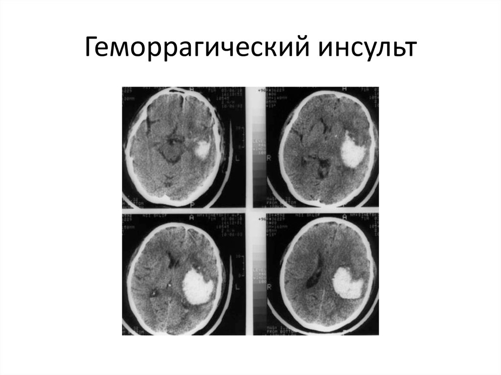 После геморрагического инсульта. Геморрагический инсульт. Геморрагический нсуль. Ґоморрогический инсульт. Геморрагический инсульт это что такое геморрагический инсульт.