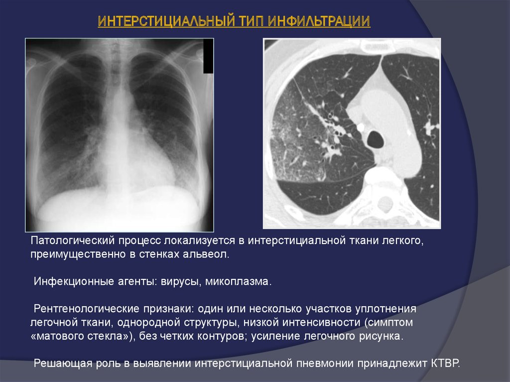 Неопластический процесс в легких. Типы инфильтрации легочной ткани на кт. Пневмония альвеолярный Тип инфильтрации рентген. Альвеолярный Тип инфильтрации при пневмонии. Интерстициальный Тип инфильтрации.