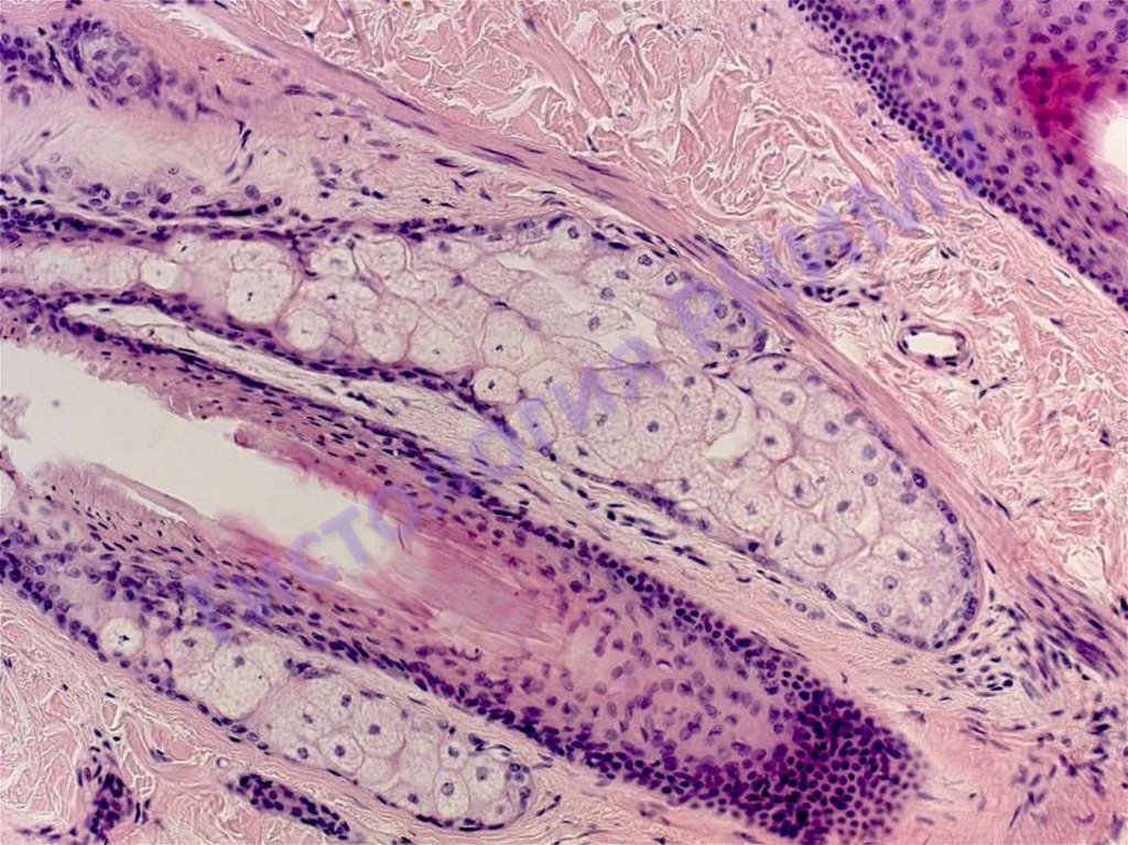 Сальная железа кожа. Сальная железа гематоксилин эозин. Гематоксилин эозин гистология. Простая альвеолярная разветвленная сальная железа кожа. Препарат №12. Простая альвеолярная разветвленная сальная железа. Кожа.