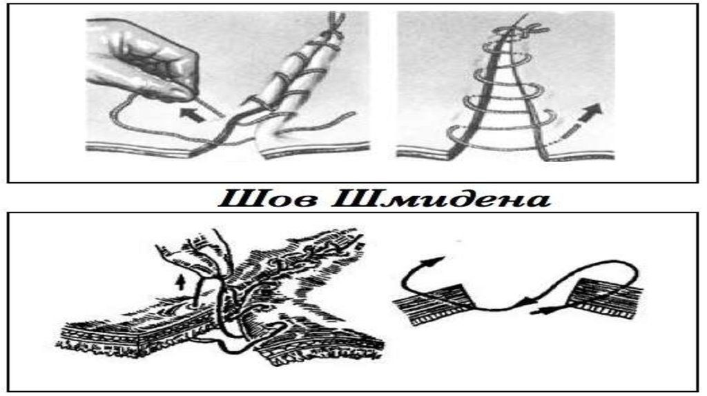 Кишечный шов презентация