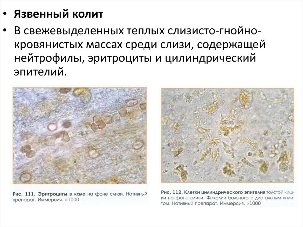 Эпителий клетки цилиндрического эпителия слизь. Копрология кала микроскопия лейкоциты. Микроскопия кала соединительная ткань. Микроскопия кала растительная клетчатка непереваримая. Микроскопия кала эритроциты.