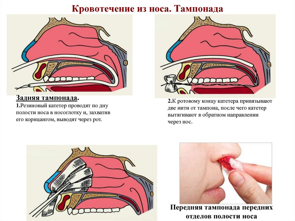 Тампонада носа при носовом кровотечении